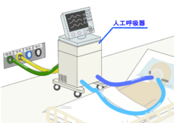 左心室補助装置 心不全に対する左心室補助装置 (LVAD)